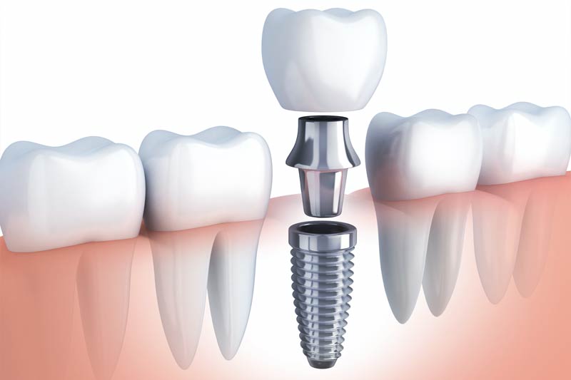 Implants Dentist in Woodland Hills