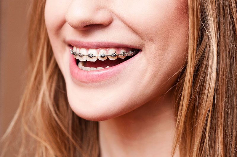 Orthodontics in Woodland Hills